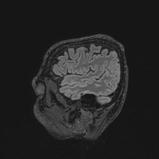 Autoimmune limbic encephalitis (Radiopaedia 30363-31005 Sagittal FLAIR 33).jpg