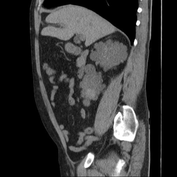 File:Autosomal dominant polycystic kidney disease (Radiopaedia 36539-38101 D 32).jpg