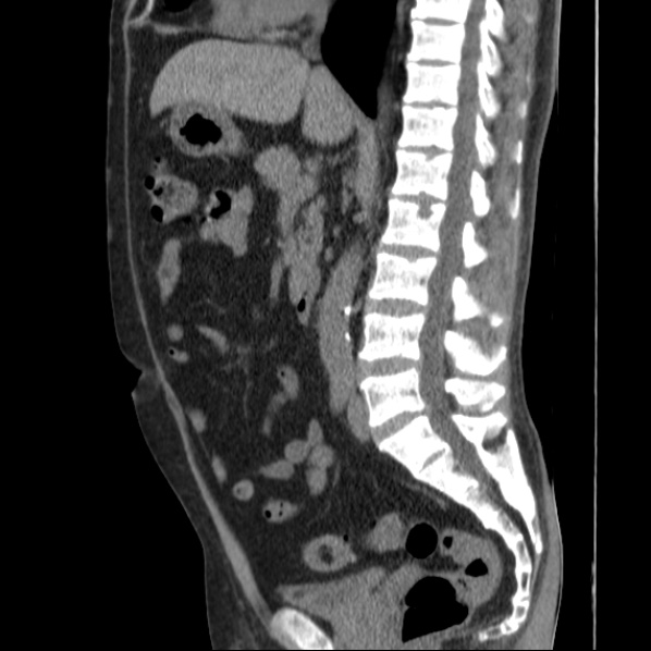 Autosomal dominant polycystic kidney disease (Radiopaedia 36539-38101 D 43).jpg