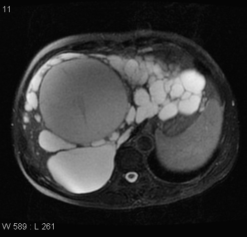 File:Autosomal dominant polycystic kidney disease (Radiopaedia 5202-6969 Axial T2 fat sat 3).jpg