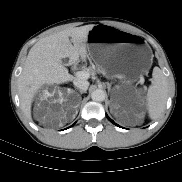 Autosomal dominant polycystic kidney disease (Radiopaedia 66349-75582 B 24).jpg