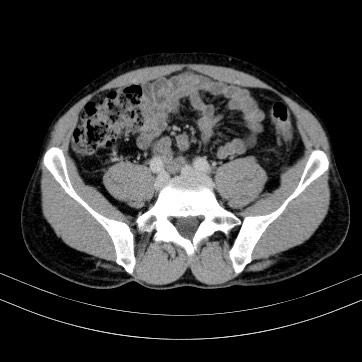 Autosomal dominant polycystic kidney disease (Radiopaedia 66349-75582 B 74).jpg