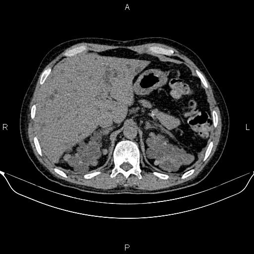 Autosomal dominant polycystic kidney disease (Radiopaedia 87830-104287 Axial non-contrast 14).jpg