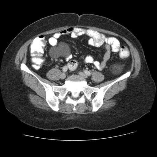 Autosomal dominant polycystic kidney disease with hepatic involvement (Radiopaedia 32693-33662 B 57).jpg