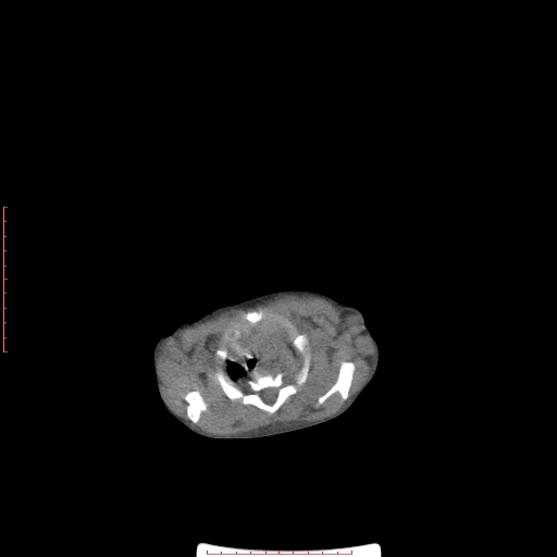 Autosomal recessive polycystic kidney disease associated with Caroli disease (Radiopaedia 61932-69984 Axial non-contrast 14).jpg