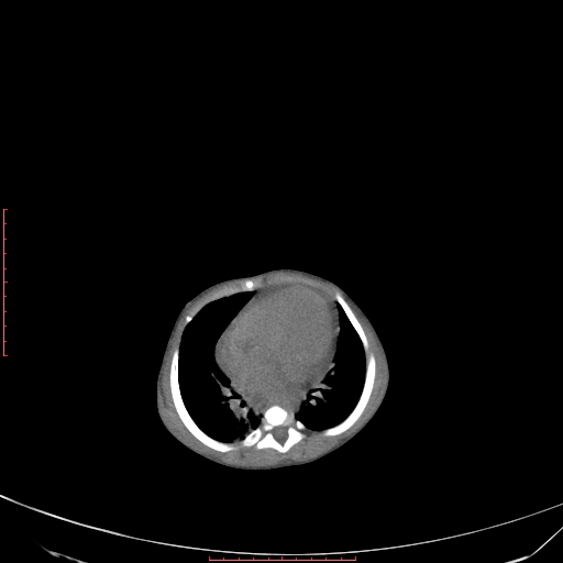 Autosomal recessive polycystic kidney disease associated with Caroli disease (Radiopaedia 61932-69984 B 68).jpg