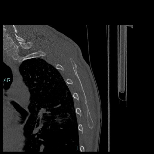Avascular necrosis after fracture dislocations of the proximal humerus (Radiopaedia 88078-104655 Sagittal bone window 84).jpg