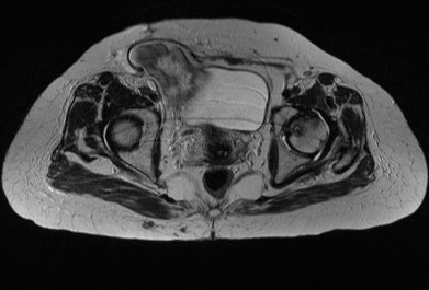 File:Avascular necrosis of the hip in renal transplant patient (Radiopaedia 7383-8236 Axial T2 1).jpg