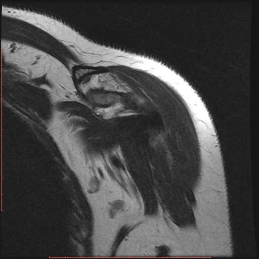 File:Avulsion fracture - greater tuberosity of humerus (Radiopaedia 25457-25703 Coronal T2 2).jpg