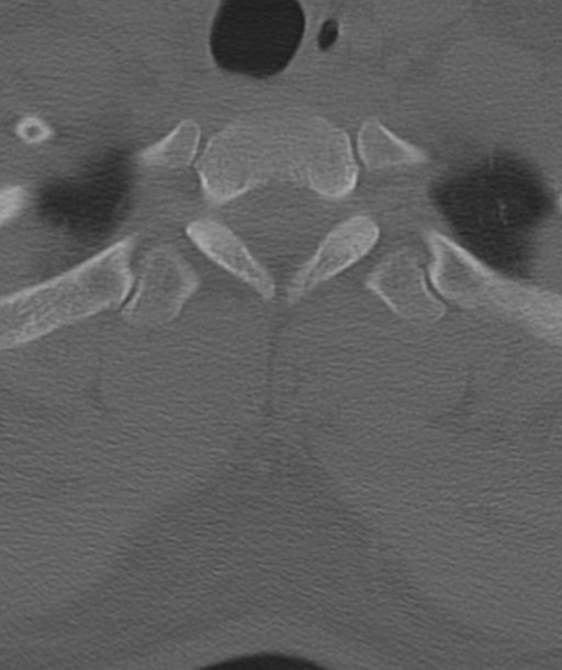Axis peg fracture (type 3) and atlas lateral mass (type 4) fracture (Radiopaedia 37474-39324 Axial bone window 53).png