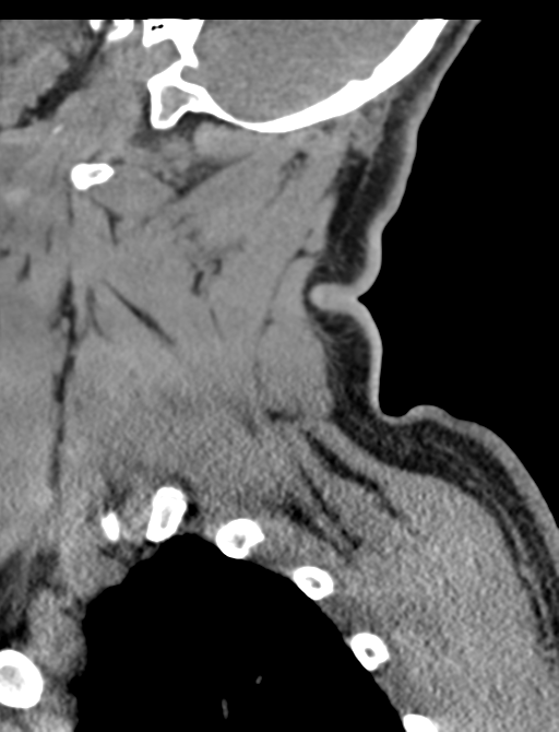 Axis peg fracture (type 3) and atlas lateral mass (type 4) fracture (Radiopaedia 37474-39324 D 12).png