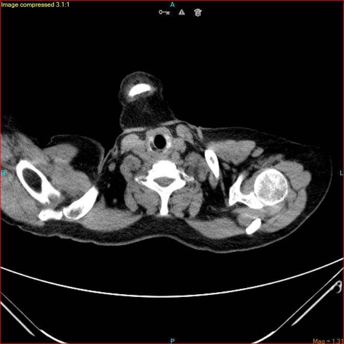 Azygos vein aneurysm (Radiopaedia 77824-90130 A 3).jpg