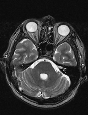 File:Balo concentric sclerosis (Radiopaedia 50458-55940 Axial T2 32).jpg