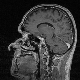 File:Balo concentric sclerosis (Radiopaedia 50458-55940 Sagittal T1 C+ 89).jpg
