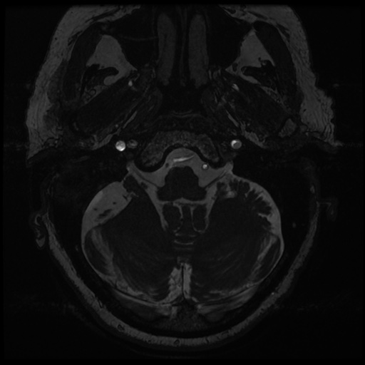 File:Balo concentric sclerosis (Radiopaedia 53875-59982 Axial T2 FIESTA 13).jpg
