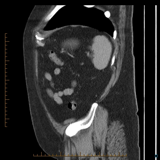 Bariatric balloon causing gastric outlet obstruction (Radiopaedia 54449-60672 C 13).jpg