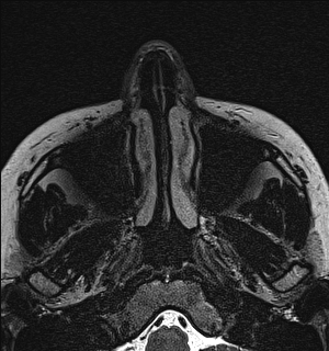 Basal cell carcinoma - nasal region (Radiopaedia 70292-80365 Axial Gradient Echo 4).jpg