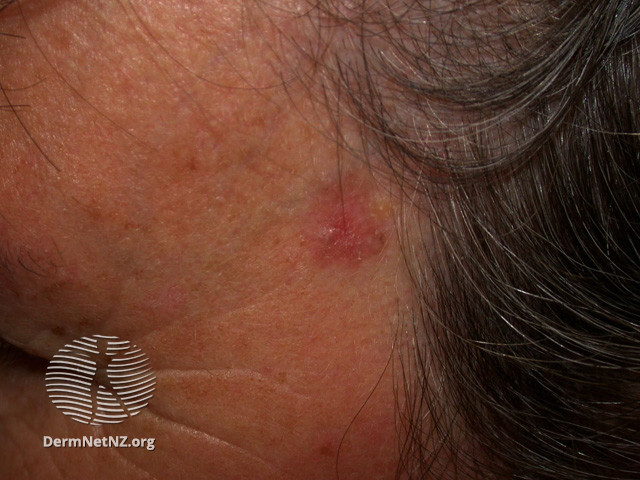 File:Basal cell carcinoma affecting the face (DermNet NZ lesions-bcc-face-0881).jpg