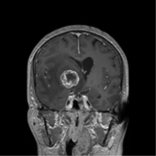 Basal ganglia metastasis (Radiopaedia 78928-91828 Coronal T1 C+ 32).png