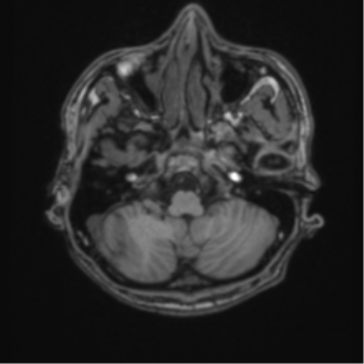 Basal ganglia subacute infarct (Radiopaedia 80201-93521 Axial T1 8).png