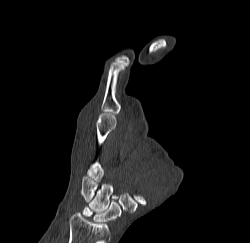 Base of 2nd metacarpal fracture (Radiopaedia 73741-84544 Coronal bone window 44).jpg
