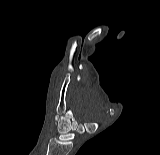 Base of 2nd metacarpal fracture (Radiopaedia 73741-84544 Coronal bone window 50).jpg