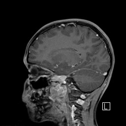 Base of skull rhabdomyosarcoma (Radiopaedia 32196-33142 J 26).jpg