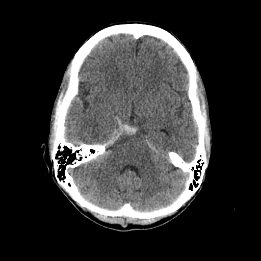 File:Basilar artery perforator aneurysm (Radiopaedia 82455-96597 Axial non-contrast 12).jpg