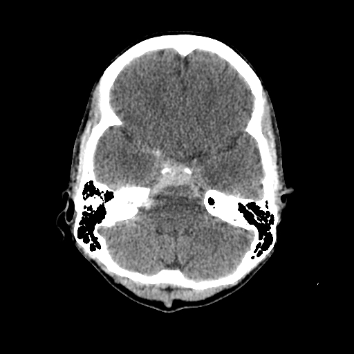 File:Basilar artery perforator aneurysm (Radiopaedia 82455-96597 Axial non-contrast 9).jpg