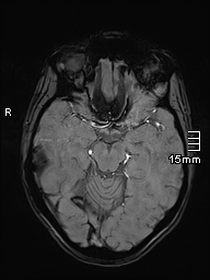 Basilar artery perforator aneurysm (Radiopaedia 82455-99523 Axial SWI 25).jpg
