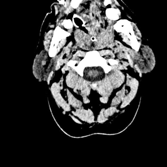 Basilar artery thrombosis (Radiopaedia 53351-59352 Axial non-contrast 5).jpg