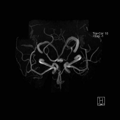 Basilar tip aneurysm (Radiopaedia 26504-26632 D 21).jpg