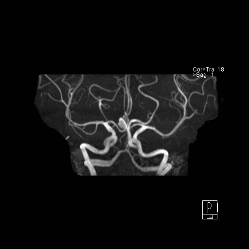 Basilar tip aneurysm (Radiopaedia 26504-26632 D 45).jpg