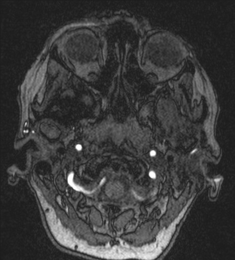 Basilar tip aneurysm (Radiopaedia 26504-26632 MRA 13).jpg