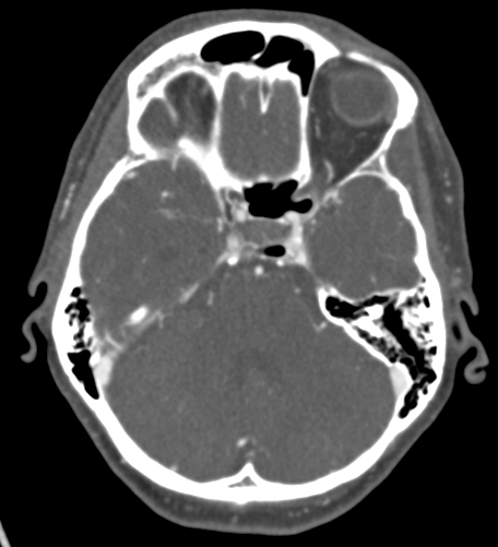 Basilar tip aneurysm with coiling (Radiopaedia 53912-60086 A 48).jpg