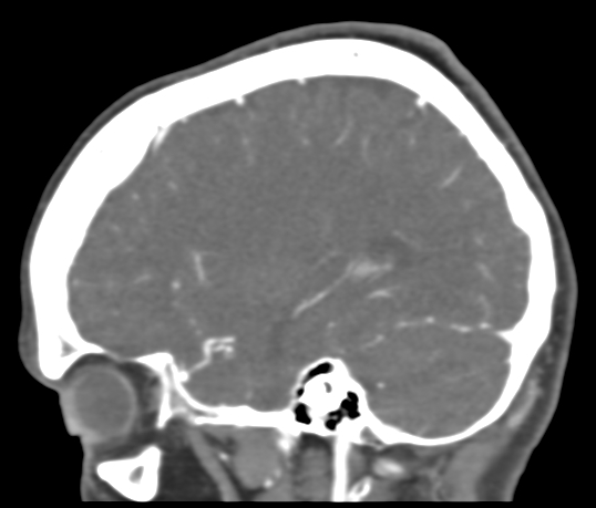 Basilar tip aneurysm with coiling (Radiopaedia 53912-60086 C 98).jpg