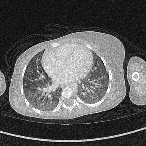 Beckwith-Wiedeman syndrome with bilateral Wilms tumors (Radiopaedia 60850-68629 Axial lung window 40).jpg