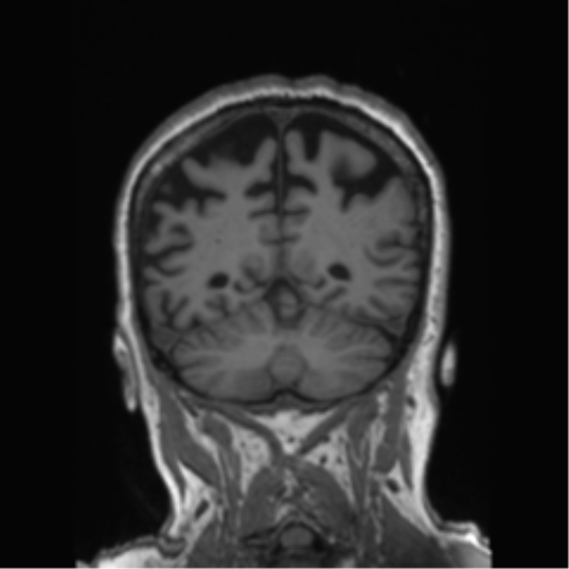 Behavioral variant frontotemporal dementia and late onset schizophrenia (Radiopaedia 52197-58083 Coronal T1 30).png