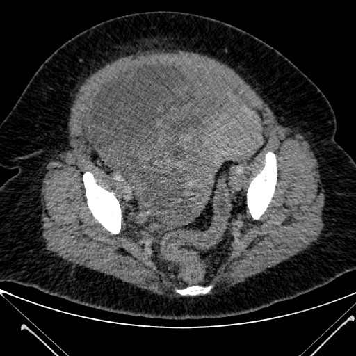 Benign leiomyoma with hydropic features (Radiopaedia 89250-106130 A 133).jpg