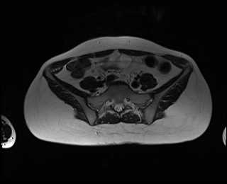 File:Bicornuate bicollis uterus (Radiopaedia 61626-69616 Axial T2 2).jpg
