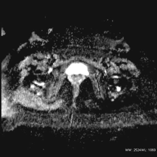 File:Bicornuate uterus- on MRI (Radiopaedia 49206-54297 Axial ADC 20).jpg