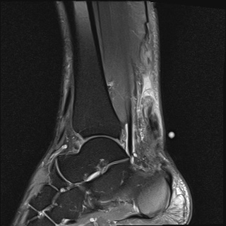 File:Bilateral Achilles tendon complete tear (Radiopaedia 81344-95051 Sagittal T2 fat sat 10).jpg