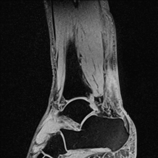 Bilateral Achilles tendon complete tear (Radiopaedia 81344-95051 Sagittal WE - Right 43).jpg