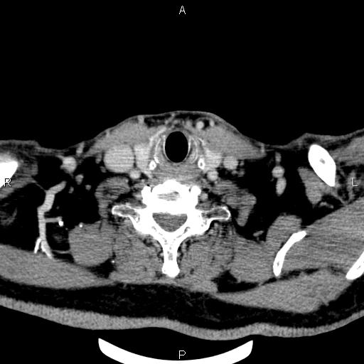 Bilateral Warthin tumors (Radiopaedia 84034-99263 Axial With contrast 52).jpg