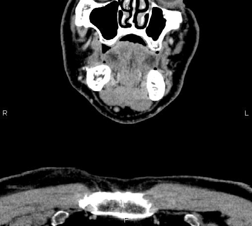 File:Bilateral Warthin tumors (Radiopaedia 84034-99263 C 8).jpg