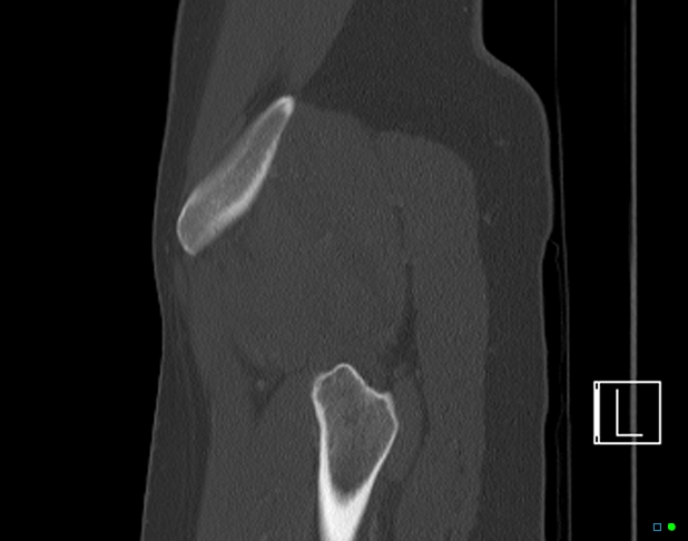Bilateral acetabular fractures (Radiopaedia 79272-92308 Sagittal bone window 80).jpg