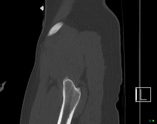 Bilateral acetabular fractures (Radiopaedia 79272-92308 Sagittal bone window 9).jpg