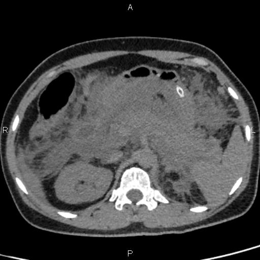 Bilateral adrenal gland hyperenhancement in pancreatitis (Radiopaedia 86642-102753 Axial non-contrast 39).jpg
