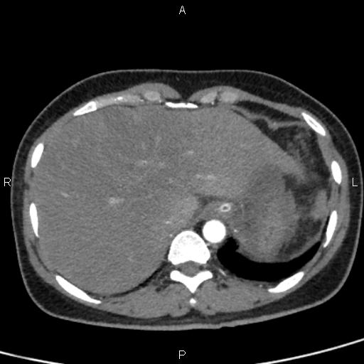 Bilateral adrenal gland hyperenhancement in pancreatitis (Radiopaedia 86642-102753 B 18).jpg