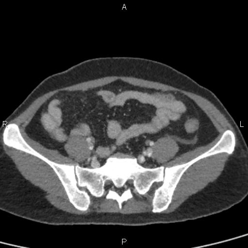 Bilateral adrenal gland hyperenhancement in pancreatitis (Radiopaedia 86642-102753 E 85).jpg